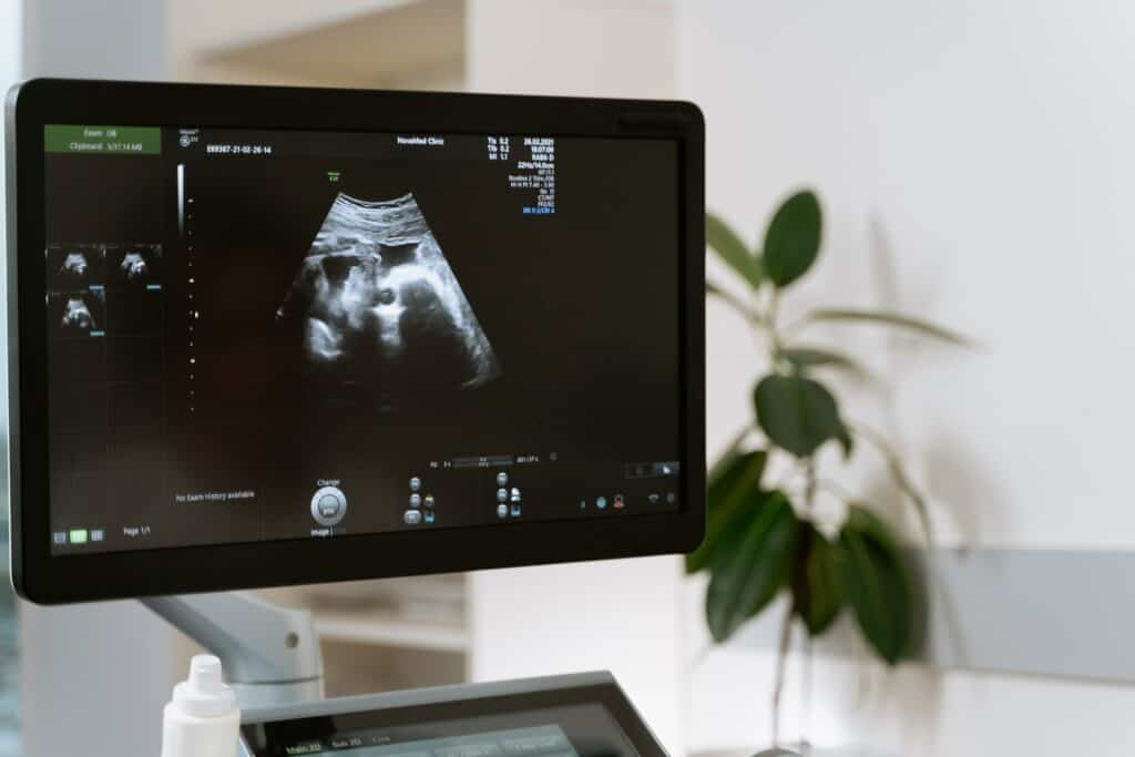 Ultra sound screen showing a developing fetus